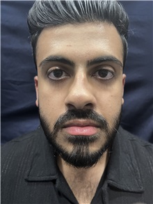 Deviated Septum Correction Before Photo by M. Zakir Sabry, MD; New York, NY - Case 50809