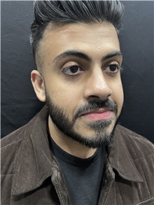 Deviated Septum Correction After Photo by M. Zakir Sabry, MD; New York, NY - Case 50809