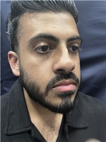 Deviated Septum Correction Before Photo by M. Zakir Sabry, MD; New York, NY - Case 50809