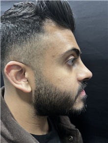 Deviated Septum Correction After Photo by M. Zakir Sabry, MD; New York, NY - Case 50809
