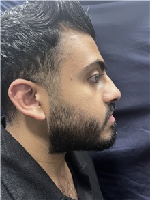 Deviated Septum Correction Before Photo by M. Zakir Sabry, MD; New York, NY - Case 50809