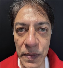 Rhinoplasty After Photo by M. Zakir Sabry, MD; New York, NY - Case 50818