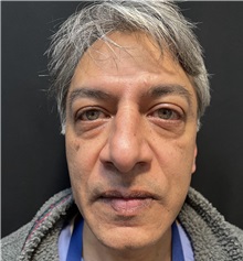 Rhinoplasty Before Photo by M. Zakir Sabry, MD; New York, NY - Case 50818