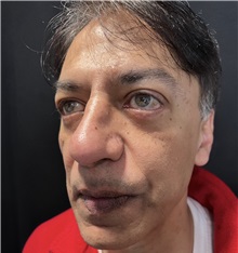 Rhinoplasty After Photo by M. Zakir Sabry, MD; New York, NY - Case 50818