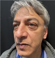Rhinoplasty Before Photo by M. Zakir Sabry, MD; New York, NY - Case 50818