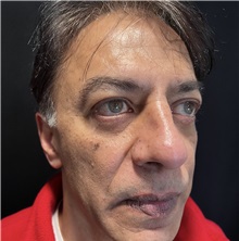 Rhinoplasty After Photo by M. Zakir Sabry, MD; New York, NY - Case 50818
