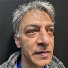 Rhinoplasty Before Photo by M. Zakir Sabry, MD; New York, NY - Case 50818