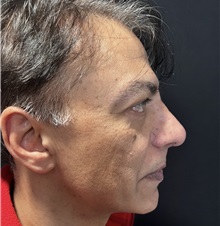 Rhinoplasty After Photo by M. Zakir Sabry, MD; New York, NY - Case 50818