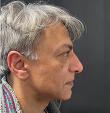 Rhinoplasty Before Photo by M. Zakir Sabry, MD; New York, NY - Case 50818