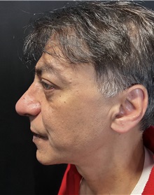 Rhinoplasty After Photo by M. Zakir Sabry, MD; New York, NY - Case 50818