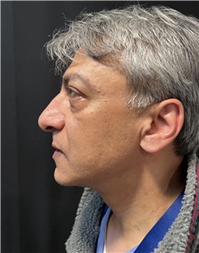 Rhinoplasty Before Photo by M. Zakir Sabry, MD; New York, NY - Case 50818