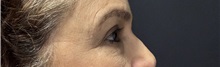 Eyelid Surgery After Photo by M. Zakir Sabry, MD; New York, NY - Case 50822