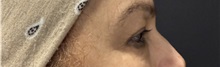 Eyelid Surgery Before Photo by M. Zakir Sabry, MD; New York, NY - Case 50822