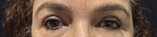 Eyelid Surgery After Photo by M. Zakir Sabry, MD; New York, NY - Case 50822