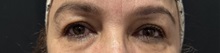 Eyelid Surgery Before Photo by M. Zakir Sabry, MD; New York, NY - Case 50822
