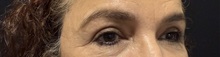 Eyelid Surgery After Photo by M. Zakir Sabry, MD; New York, NY - Case 50822