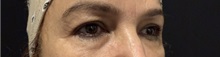 Eyelid Surgery Before Photo by M. Zakir Sabry, MD; New York, NY - Case 50822