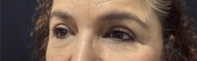 Eyelid Surgery After Photo by M. Zakir Sabry, MD; New York, NY - Case 50822