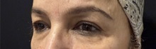 Eyelid Surgery Before Photo by M. Zakir Sabry, MD; New York, NY - Case 50822