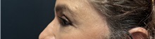 Eyelid Surgery After Photo by M. Zakir Sabry, MD; New York, NY - Case 50822