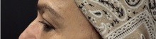 Eyelid Surgery Before Photo by M. Zakir Sabry, MD; New York, NY - Case 50822
