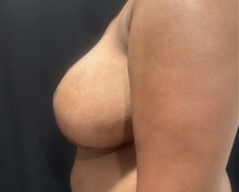 Breast Reduction After Photo by M. Zakir Sabry, MD; New York, NY - Case 51041