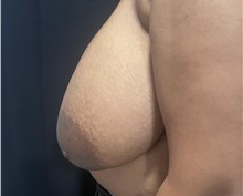 Breast Reduction Before Photo by M. Zakir Sabry, MD; New York, NY - Case 51041