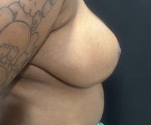 Breast Reduction After Photo by M. Zakir Sabry, MD; New York, NY - Case 51041