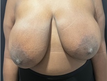 Breast Reduction Before Photo by M. Zakir Sabry, MD; New York, NY - Case 51082