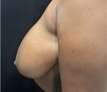 Breast Reduction Before Photo by M. Zakir Sabry, MD; New York, NY - Case 51082