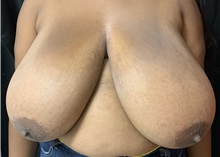 Breast Reduction Before Photo by M. Zakir Sabry, MD; New York, NY - Case 51083