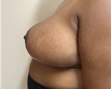 Breast Reduction After Photo by M. Zakir Sabry, MD; New York, NY - Case 51083