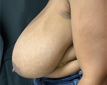 Breast Reduction Before Photo by M. Zakir Sabry, MD; New York, NY - Case 51083