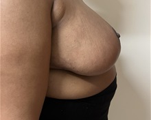 Breast Reduction After Photo by M. Zakir Sabry, MD; New York, NY - Case 51083