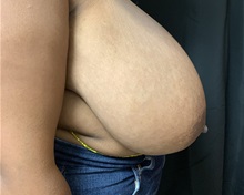 Breast Reduction Before Photo by M. Zakir Sabry, MD; New York, NY - Case 51083