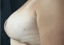 Breast Reduction After Photo by M. Zakir Sabry, MD; New York, NY - Case 51084
