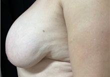 Breast Reduction Before Photo by M. Zakir Sabry, MD; New York, NY - Case 51084
