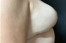 Breast Reduction After Photo by M. Zakir Sabry, MD; New York, NY - Case 51084