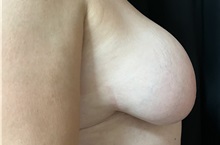 Breast Reduction Before Photo by M. Zakir Sabry, MD; New York, NY - Case 51084