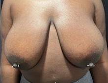 Breast Reduction Before Photo by M. Zakir Sabry, MD; New York, NY - Case 51086