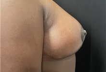 Breast Reduction After Photo by M. Zakir Sabry, MD; New York, NY - Case 51086