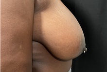 Breast Reduction Before Photo by M. Zakir Sabry, MD; New York, NY - Case 51086