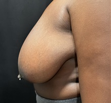 Breast Reduction Before Photo by M. Zakir Sabry, MD; New York, NY - Case 51086