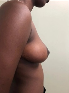 Breast Reduction After Photo by M. Zakir Sabry, MD; New York, NY - Case 51175