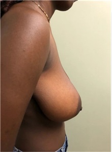 Breast Reduction Before Photo by M. Zakir Sabry, MD; New York, NY - Case 51175