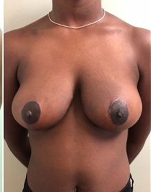 Breast Reduction After Photo by M. Zakir Sabry, MD; New York, NY - Case 51175