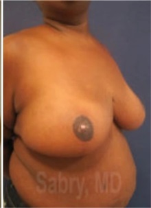 Breast Reduction After Photo by M. Zakir Sabry, MD; New York, NY - Case 51176
