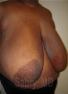Breast Reduction Before Photo by M. Zakir Sabry, MD; New York, NY - Case 51176