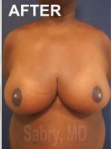 Breast Reduction After Photo by M. Zakir Sabry, MD; New York, NY - Case 51176
