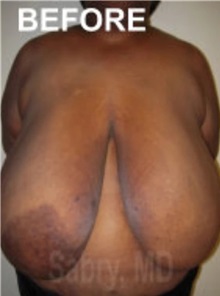 Breast Reduction Before Photo by M. Zakir Sabry, MD; New York, NY - Case 51176